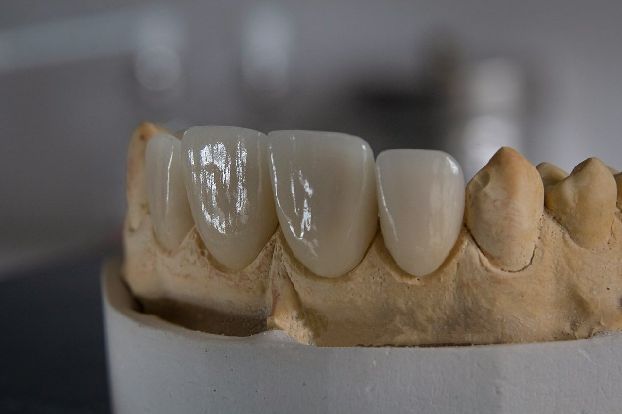 Carga inmediata en implantes: ¿es posible tener dientes el mismo día?